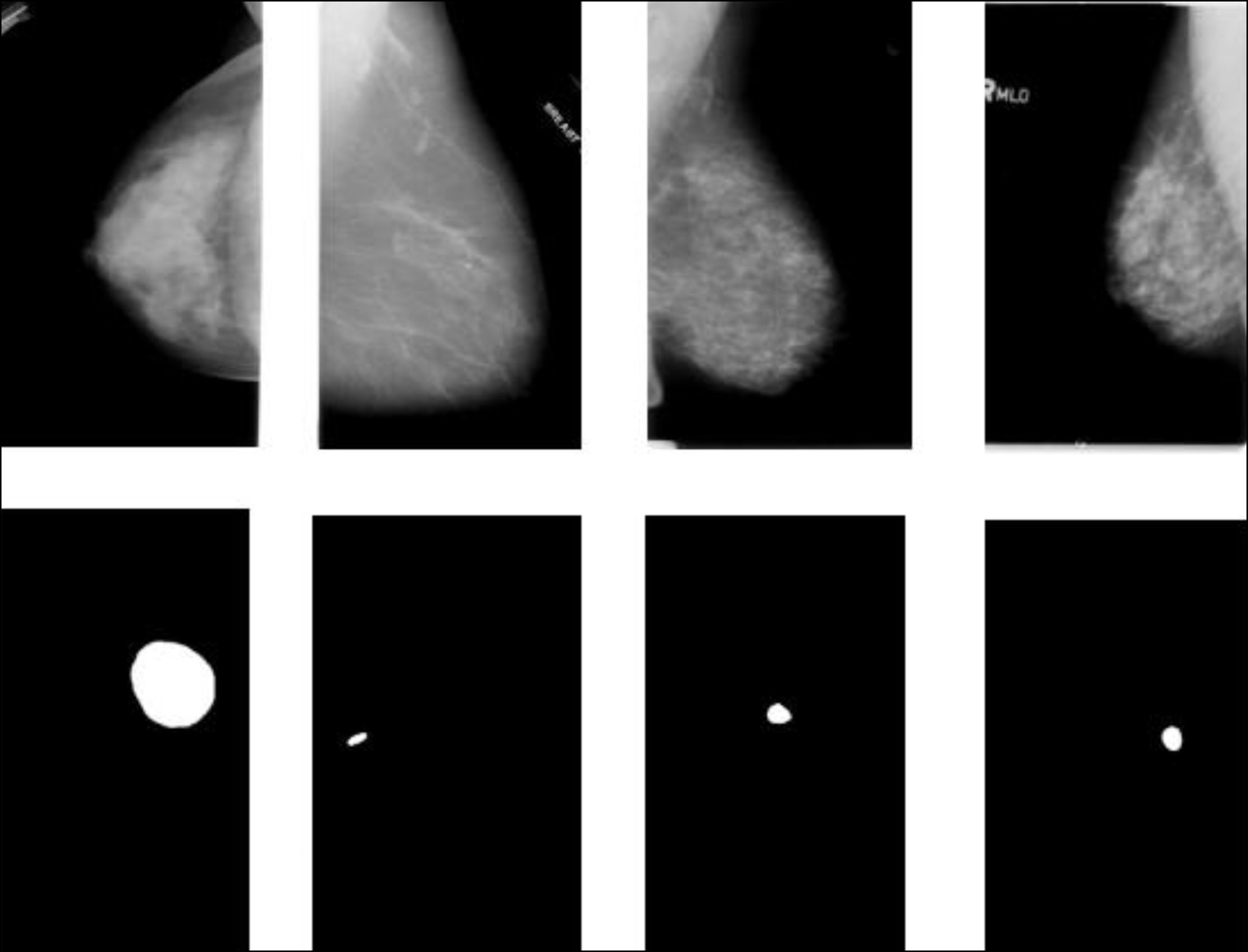 利用机器学习方法诊断乳腺癌